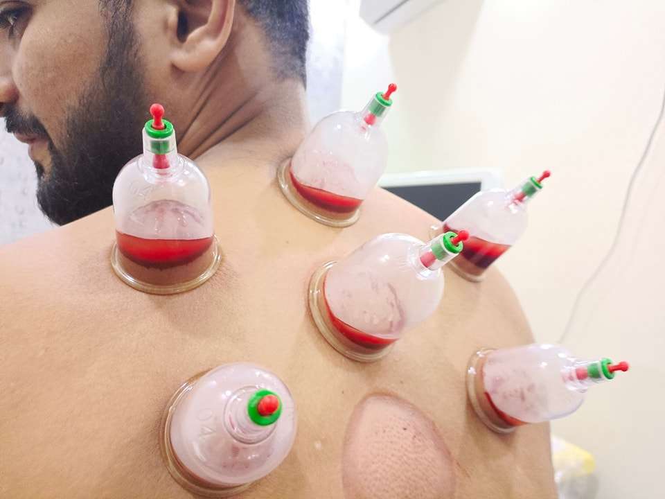 Hijama Therapy